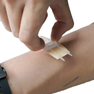 Dispositivo de Cierre de Heridas Médico, Sutura No Invasiva, Grapadora de Superficie Cutánea, Zip Stitch - Product Image 2