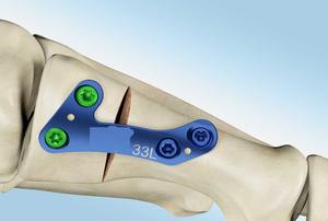 Renix International's New Style 90 degrés gauche Hallux-Valgus plaque de verrouillage titane 2 trous côté 33mm longueur cheveux manuels - Product Image 4