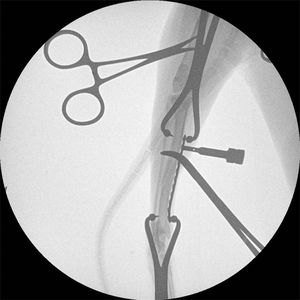 آلة تنظير الذراع PFD C لجراحة الأشعة مع نظام ذراع رقمي C جهاز أشعة <span class=keywords><strong>X</strong></span> - Product Image 2