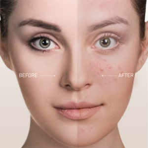 Sérum de soin de l'acné de marque privée OEM de 50ml caractéristique de l'huile de feuille de Melaleuca Alternifolia personnalisable pour votre marque - Product Image 5