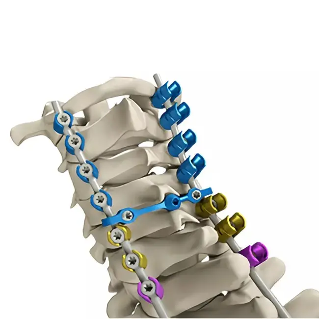 Sistema di viti per impianti ortopedici di prezzo della vite pedicile poliassiale in titanio della colonna vertebrale cervicale di fabbrica