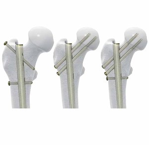 Nieuwste Ontwerp Intramedullaire Nagel Voor Trauma Implantaat <span class=keywords><strong>Titanium</strong></span> Tibiale <span class=keywords><strong>Femur</strong></span> Orthopedische Chirurgische Basis Chirurgische Instrumenten