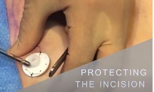 Ensemble de 3 pièces de couverture de peau pour canule de liposuccion en clinique de liposuccion protecteur de peau autoclavable - Product Image 3