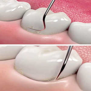 Kit de microcirugía oral Juego de Instrumentos dentales de acero inoxidable alemán para cirugía periodontal POR NAVEL - Product Image 3