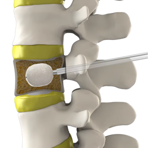 osseodenification การปลูกถ่ายกระดูกเกี่ยวกับศัลยกรรมกระดูก, ขนาด-X 20มม. ภาชนะบรรจุปูนซีเมนต์ - Product Image 1
