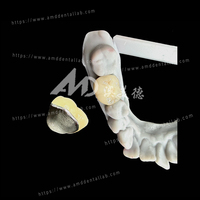Jembatan Gigi PFM (Porcelain Fused to Metal) dan Mahkota yang Andal untuk Restorasi Gigi yang Fungsional dan Estetis