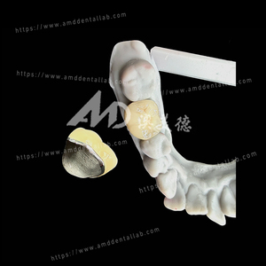 Pont <span class=keywords><strong>dentaire</strong></span> en porcelaine fusionnée au métal (PFM) fiable, couronne pour une restauration <span class=keywords><strong>dentaire</strong></span> fonctionnelle et esthétique - Product Image 4