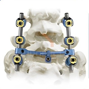 Implantes ortopédicos para traumatismos Clavo de titanio entrelazado Clavo intramedular humeral de bloqueo múltiple de Surgiright - Product Image 1