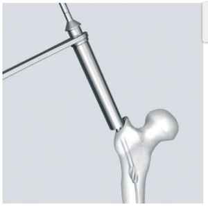 Ongles longs intramédullaires fémoraux experts (09 DROITE/GAUCHE) - Product Image 3