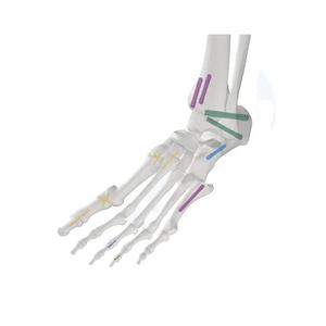 Implante ortopédico para cirugía de columna vertebral, tornillo de fijación interna ortopédica, quirúrgico, el mejor tornillo monopoaxial - Product Image 6