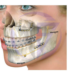 Mini placas óseas ortopédicas veterinarias con hueco 1,5mm Instrumentos de Cirugía Maxilofacial de fijación ósea quirúrgica - Product Image 2