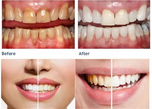 เครื่องเลเซอร์ไดโอดเพื่อ<span class=keywords><strong>ฟัน</strong></span>ขาวแบบพกพา1470nm 980nm เลเซอร์เอนโดโลเซอร์ยกกระชับร่างกาย - Product Image 2