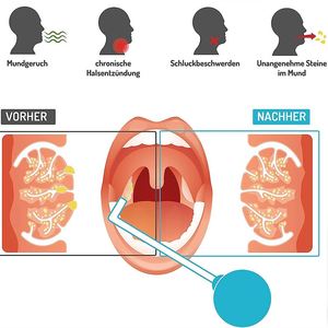 Nouveauté : Outil d'élimination des calculs, dispositif d'aspiration à tube fin en verre pour la gorge, nettoyeur buccal pour <span class=keywords><strong>les</strong></span> calculs, blanchiment des dents - Product Image 3