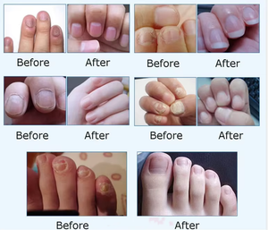 980nm + 1470nm Eliminación <span class=keywords><strong>de</strong></span> hongos en las uñas Máquina Láser <span class=keywords><strong>de</strong></span> Diodo Dispositivo láser <span class=keywords><strong>de</strong></span> lipólisis <span class=keywords><strong>de</strong></span> fibra óptica - Product Image 3