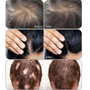 5 en 1 analyseur de soins du cuir chevelu des cheveux repousse <span class=keywords><strong>Massage</strong></span> croissance elctrothérapie pour la croissance des cheveux analyse électrique enlèvement de la Machine - Product Image 3