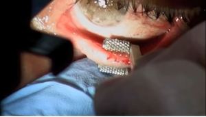 Rodillos de Acero Inoxidable para Eliminar las Glándulas de Meibomio, Pinzas de Extracción Manual para Cirugía Oftálmica, CE ISO - Product Image 4