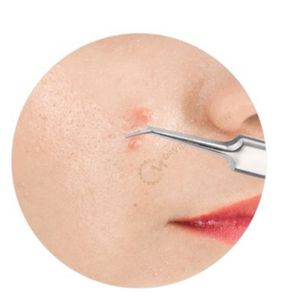 แหนบกำจัดสิวหัวดำและสิวแบบมืออาชีพเครื่องมือดูแลผิวที่ใช้แล้วสำหรับกำจัดสิวสีดำ - Product Image 6