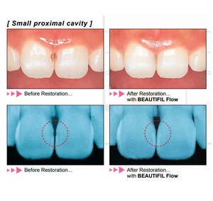 Material Restaurador Fluido Único de Bajo Flujo Beautiful Flow F02 para el Área Cervical, Jeringa de 2 g con Puntas - Product Image 2