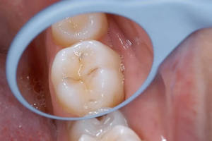 Espejo Bucal Dental Profesional de Acero Inoxidable, Disponible en Todos los Colores y Diseños, Espejo Bucal Dental 2026 - Product Image 2