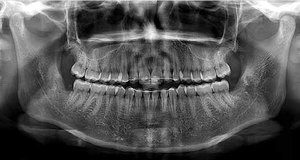 İtalya MyRay Hyperion X9 Dijital 3'ü 1 Arada Diş CBCT Cihazı, Ceph Özellikli Diş Panoramik Cihazı - Product Image 6