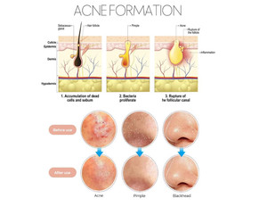 Mụn đầu đen Remover mụn Popper công cụ <span class=keywords><strong>Kit</strong></span> 7pcs mụn đầu đen Tweezer mụn extractor loại bỏ mụn trứng cá công cụ với Túi da - Product Image 5