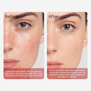 Gel adoucissant réparateur de croûtes à marque privée, sérum de récupération post-procédure pour le soin esthétique du visage - Product Image 5
