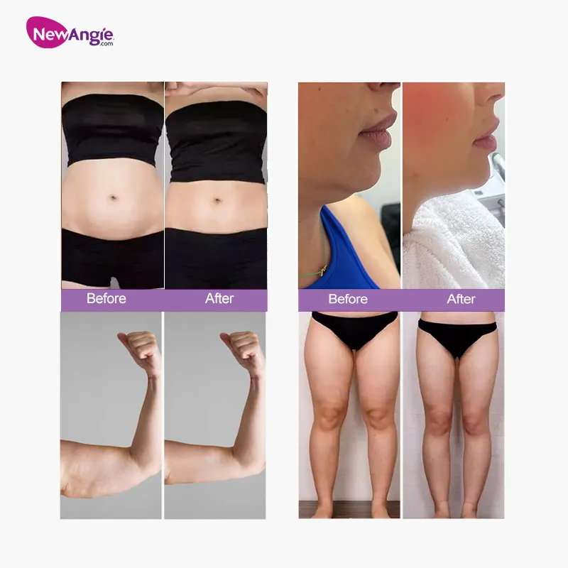 Newangie trusculpt ID Flex mỏng cơ thể điêu khắc máy cơ thể Giảm Béo vẻ đẹp trusculpt 3D RF thiết bị giảm béo