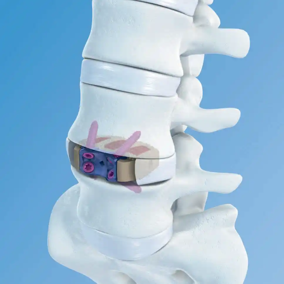 צוואר הרחם יציב היתוך כלוב Rebar מכשירי ניתוח אורטופדי גבוהה באיכות כלובי נקבובי הצצה פתרון השדרה Implannts