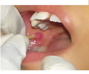 Gel Sellador Quirúrgico Dental Progel B, Sellador de Tejidos Biocompatible para Uso Clínico - Product Image 3