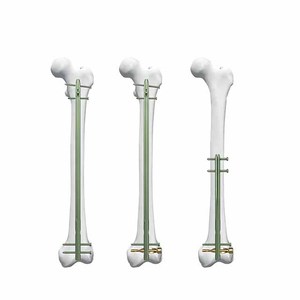 Professionele Hoge Kwaliteit Titanium Dfn Distale <span class=keywords><strong>Femur</strong></span> Intramedullaire In Elkaar Grijpende Nagel Orthopedische Chirurgische Instrumenten Basis - Product Image 2