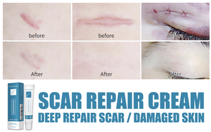 Crème réparatrice de cicatrices à base de plantes douce, formule sans parfum à base d'extraits de plantes pour adultes, lisse les cicatrices bosselées, utilisation corporelle, 20 ml - Product Image 4