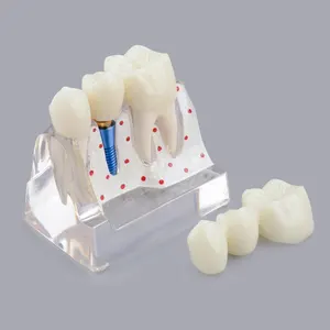 Transparent Dental Implant Model for Patient Education, Dental Implant, Crown and Bridge Teeth Model for Presentation