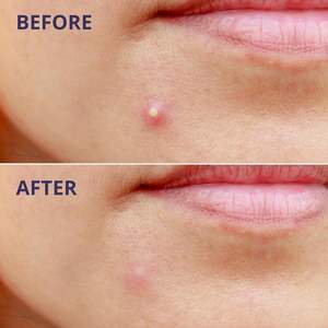 Melhor Adesivo Hidrocolóide para Acne Cobertura Duradoura Uso Diurno Adesivo Invisível para Tratamento de Espinhas - Product Image 5