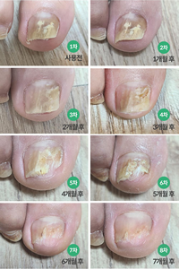 Pedi Saver suero efectivo para hongos negros uñas verdes paroniquia pie spa terapia de pies hongo Uña de los pies - Product Image 6