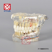 Modelo de estudio dental modelo de demostración clínica mplant todo en un modelo con nervio