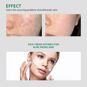 Crème Booster Anti-Acné Personnalisée à la Centella Asiatica <span class=keywords><strong>pour</strong></span> Peaux Grasses, Extrait d'Arbre à Thé, Baume Hydratant Éliminateur de Cicatrices d'Acné - Product Image 5