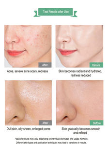 OEM ฉลากส่วนตัวผลิตภัณฑ์ดูแลผิวเซรั่มซ่อมแซมผิว การกําจัดรอยแตกลายสิว เรตินอล ชาต้นไม้ใบหน้า เซรั่มต่อต้านสิว - Product Image 4