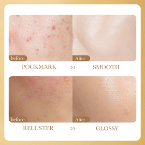 SADOER yüz serumu Nicotinamide <span class=keywords><strong>C</strong></span> vitamini nemlendirici anti-akne özel etiket anti-kırışıklık liyofilize toz cilt bakımı seti - Product Image 6