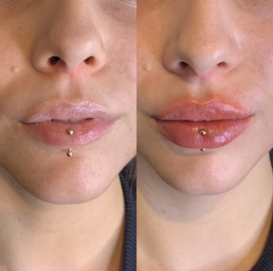 CE Professional Lips Filler 1ml 2ml 3ml 5ml Pure BDDE Cross Linked Hyaluronic Acid Dermal Filler Lip Plump Volume <span class=keywords><strong>Injection</strong></span> - Product Image 2
