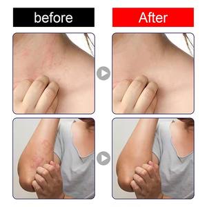 Оптовая продажа, новый травяной крем от экземы для детей, крем от псориаза, медицинское обслуживание - Product Image 5