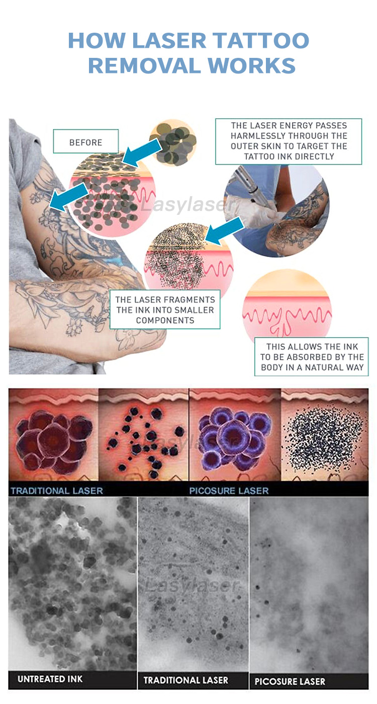 Nd:YAG picosecond laser instrument equipment to remove wrinkles and scars to lighten pores and improve acne