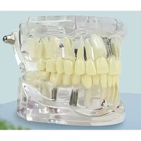Modèle anatomique dentaire standard de pont amovible pour la restauration des dents, Typodont, Modèle de maladie implantaire, Matériau PVC, Vert, Science Médicale