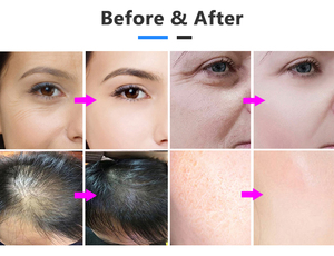 Portable Hair Loss Electroporation Mesotherapy Machine Skin Rejuvenation No-needle Mesotherapy Device - Product Image 2