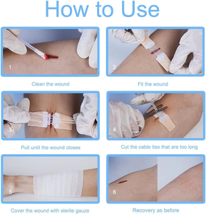 อุปกรณ์ปิดแผลฉุกเฉิน ชุดอุปกรณ์ปิดแผลด้วยโอโซนพร้อมแถบซิปสติทช์ ชุดเย็บแผล แผ่นปิดแผลชนิดซิปสติทช์ สำหรับซ่อมแซมแผลระดับ Class I ผลิตแบบ OEM - Product Image 3