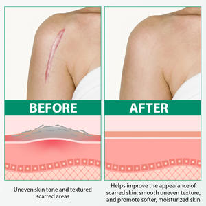 Crème réparatrice de vergetures et de cicatrices anciennes en silicone ALIVER, crème <span class=keywords><strong>anti</strong></span>-cicatrices avancée contre les taches de rousseur pour tous les types de peau - Product Image 4