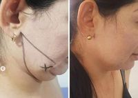 Machine laser chirurgicale médicale, machine de liposuccion par laser lipo, lipolyse, 980+1470nm Endolaser Fibra, lifting facial