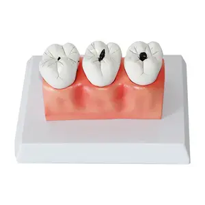 치과 치과 구강 건강 병적 충치 치아 모델 아이의 해부학 모델 충치 모델