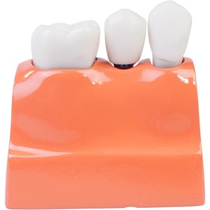 Modèle d'implant dentaire oral avec couronne et pont amovibles, adapté à la démonstration et à la formation des étudiants en dentisterie - Product Image 3