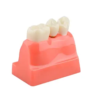 Modello di impianto dentale per l'educazione del paziente 4 volte modello di corona e ponte per impianto dentale per la presentazione-rosa
