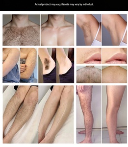 Máquina Portátil Patentada de Depilación Láser de Diodo 808/755/1064nm, Rejuvenecimiento Permanente de la Piel - Product Image 6